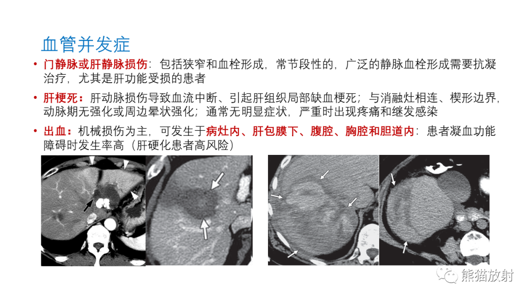 影像PPT - 【PPT】HCC热消融治疗后影像表现解读及报告标准-25