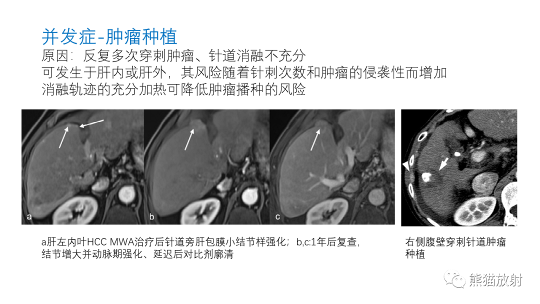 影像PPT - 【PPT】HCC热消融治疗后影像表现解读及报告标准-30