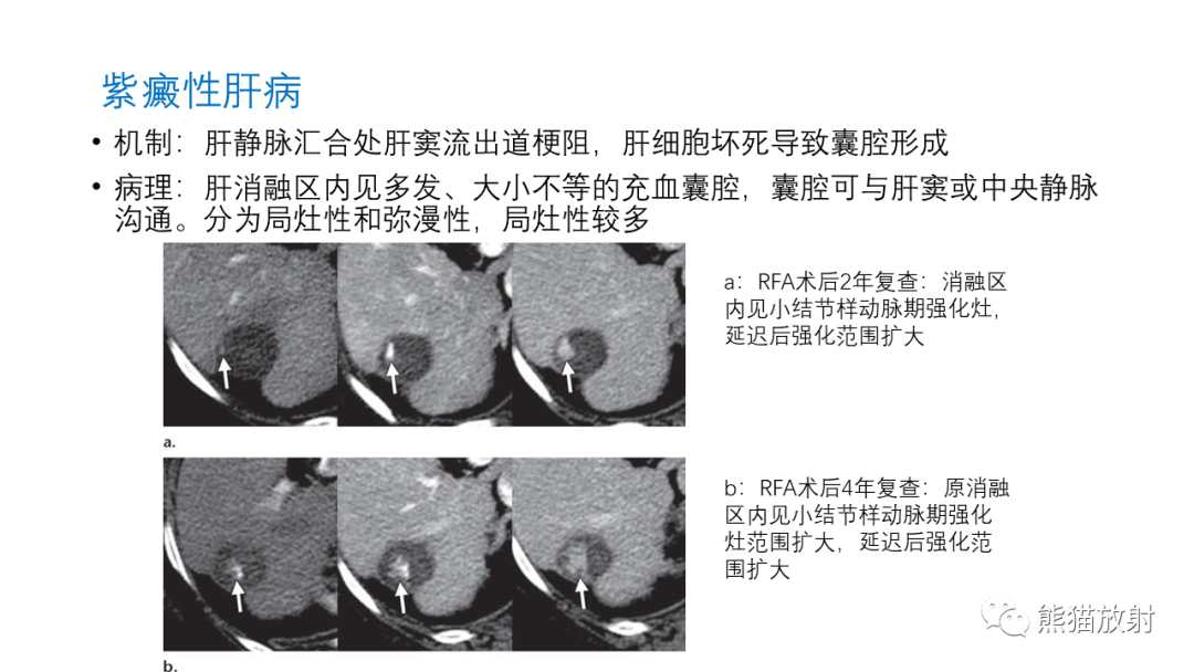 影像PPT - 【PPT】HCC热消融治疗后影像表现解读及报告标准-33