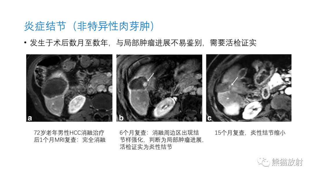 影像PPT - 【PPT】HCC热消融治疗后影像表现解读及报告标准-34