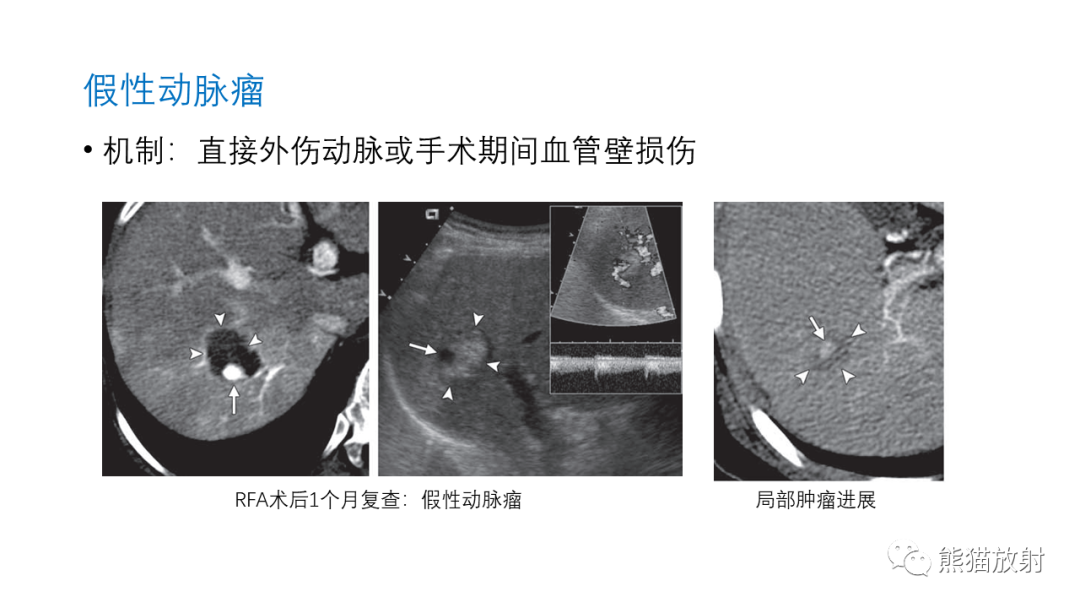 影像PPT - 【PPT】HCC热消融治疗后影像表现解读及报告标准-35