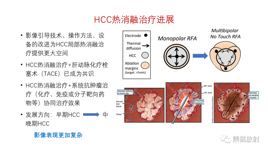 影像PPT - 【PPT】HCC热消融治疗后影像表现解读及报告标准-36