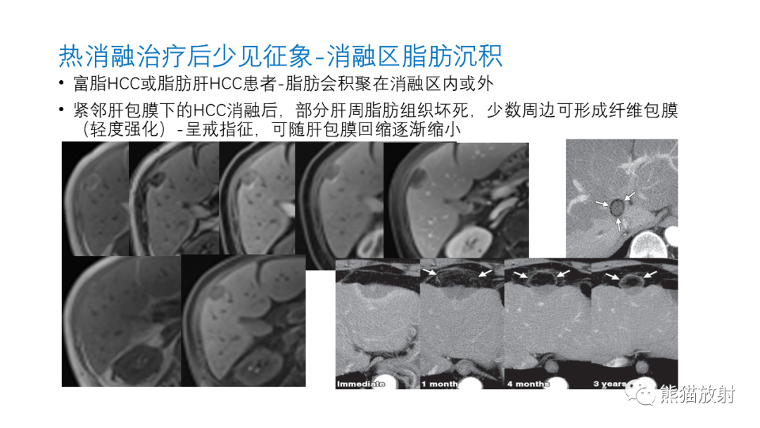 影像PPT - 【PPT】HCC热消融治疗后影像表现解读及报告标准-32