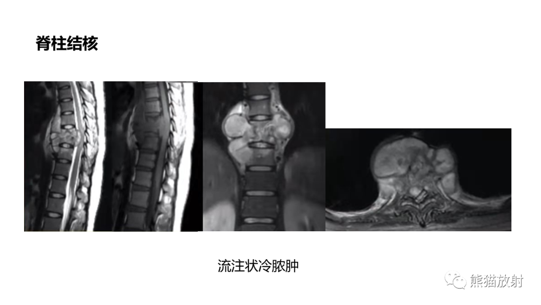 影像PPT - 【病例】椎体浆细胞瘤 VS 淋巴瘤-32