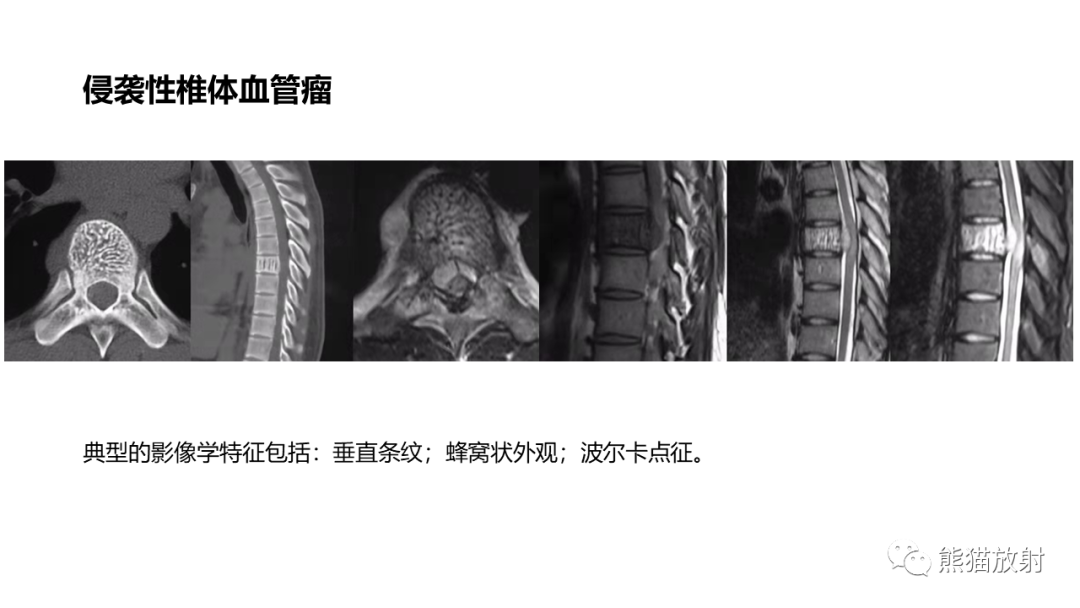 影像PPT - 【病例】椎体浆细胞瘤 VS 淋巴瘤-34