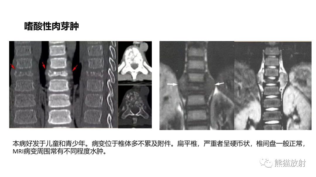 影像PPT - 【病例】椎体浆细胞瘤 VS 淋巴瘤-33