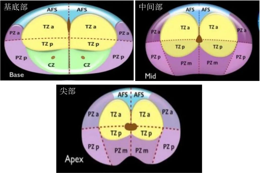 影像PPT - 前列腺磁共振PI-PARS V2.1及正确的报告书写-11 影像PPT - 前列腺磁共振PI-PARS V2.1及正确的报告书写-11