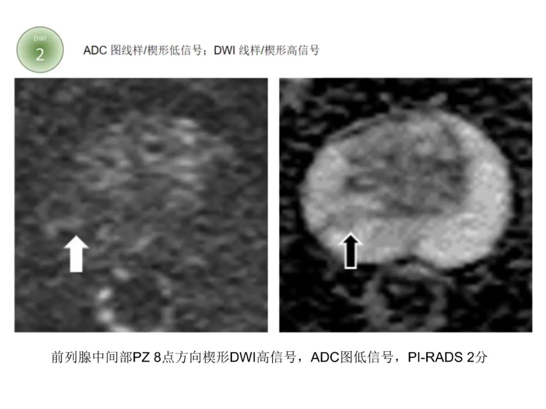 影像PPT - 前列腺磁共振PI-PARS V2.1及正确的报告书写-19 影像PPT - 前列腺磁共振PI-PARS V2.1及正确的报告书写-19