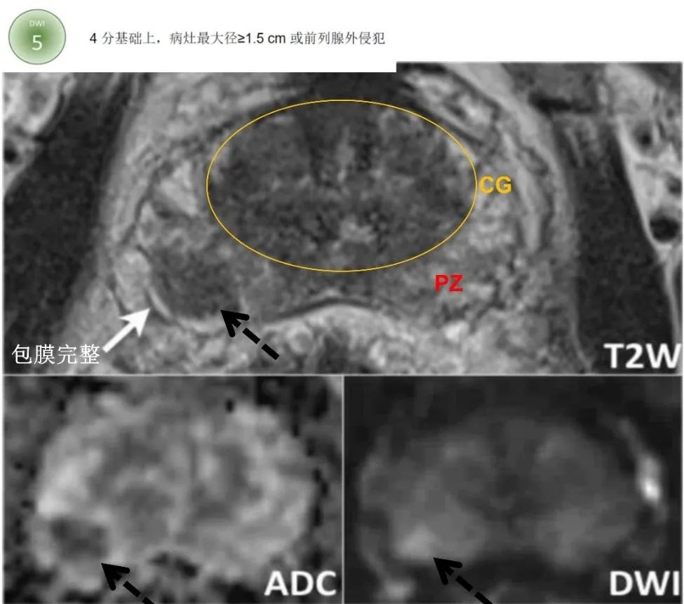 影像PPT - 前列腺磁共振PI-PARS V2.1及正确的报告书写-21 影像PPT - 前列腺磁共振PI-PARS V2.1及正确的报告书写-21