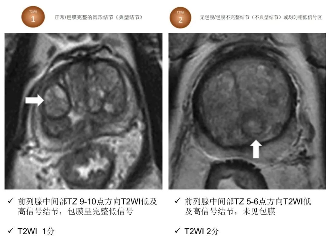影像PPT - 前列腺磁共振PI-PARS V2.1及正确的报告书写-24 影像PPT - 前列腺磁共振PI-PARS V2.1及正确的报告书写-24