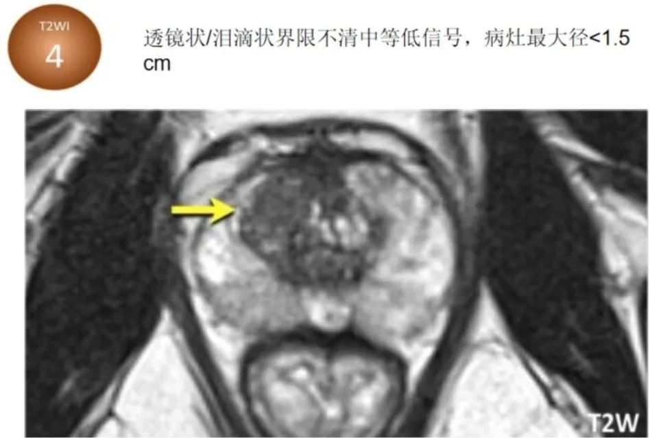 影像PPT - 前列腺磁共振PI-PARS V2.1及正确的报告书写-25 影像PPT - 前列腺磁共振PI-PARS V2.1及正确的报告书写-25