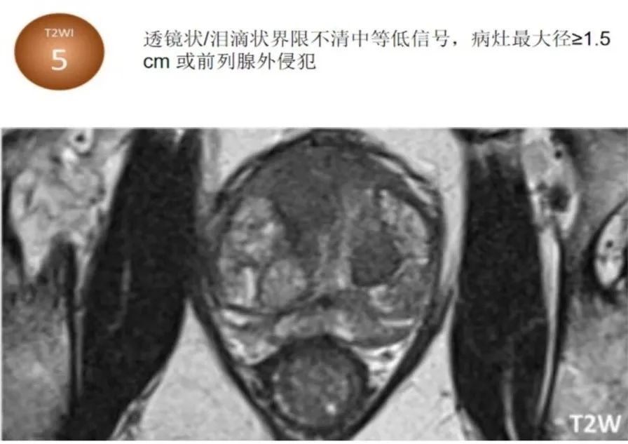 影像PPT - 前列腺磁共振PI-PARS V2.1及正确的报告书写-26 影像PPT - 前列腺磁共振PI-PARS V2.1及正确的报告书写-26