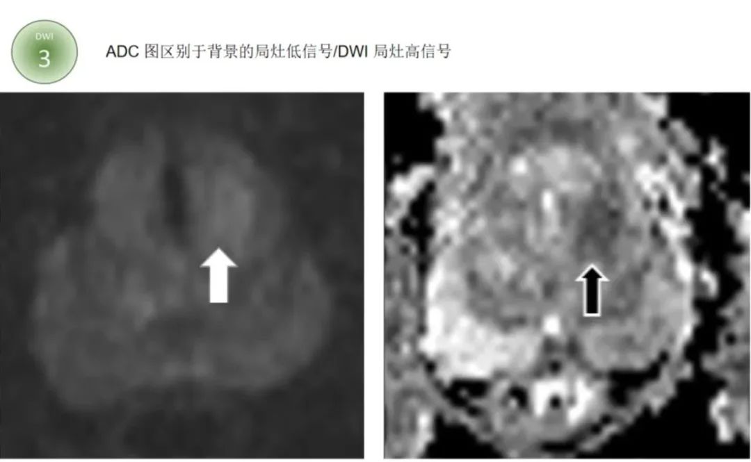 影像PPT - 前列腺磁共振PI-PARS V2.1及正确的报告书写-27 影像PPT - 前列腺磁共振PI-PARS V2.1及正确的报告书写-27