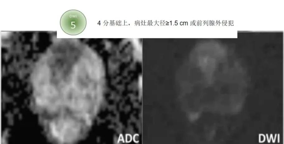 影像PPT - 前列腺磁共振PI-PARS V2.1及正确的报告书写-29 影像PPT - 前列腺磁共振PI-PARS V2.1及正确的报告书写-29