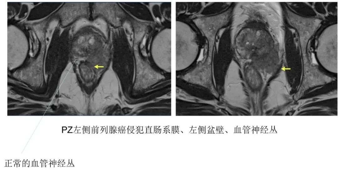影像PPT - 前列腺磁共振PI-PARS V2.1及正确的报告书写-31 影像PPT - 前列腺磁共振PI-PARS V2.1及正确的报告书写-31