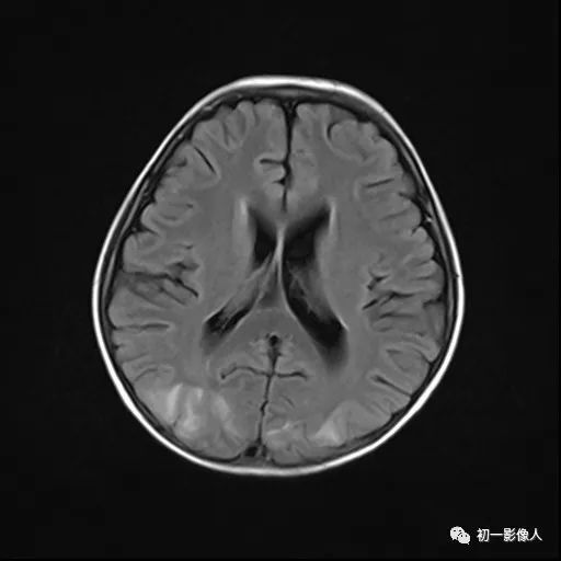 影像PPT - 可逆性后部脑白质病-2 影像PPT - 可逆性后部脑白质病-2