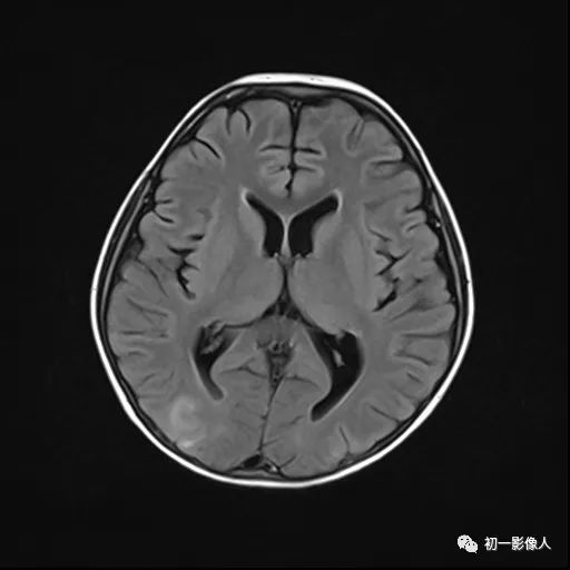 影像PPT - 可逆性后部脑白质病-3 影像PPT - 可逆性后部脑白质病-3