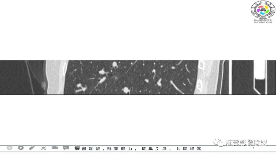 影像PPT - 【病例】 左右为难的肺结节-12 影像PPT - 【病例】 左右为难的肺结节-12