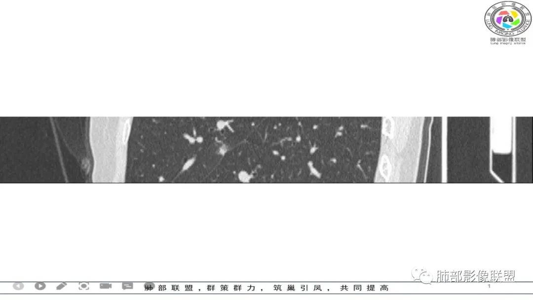 影像PPT - 【病例】 左右为难的肺结节-21 影像PPT - 【病例】 左右为难的肺结节-21