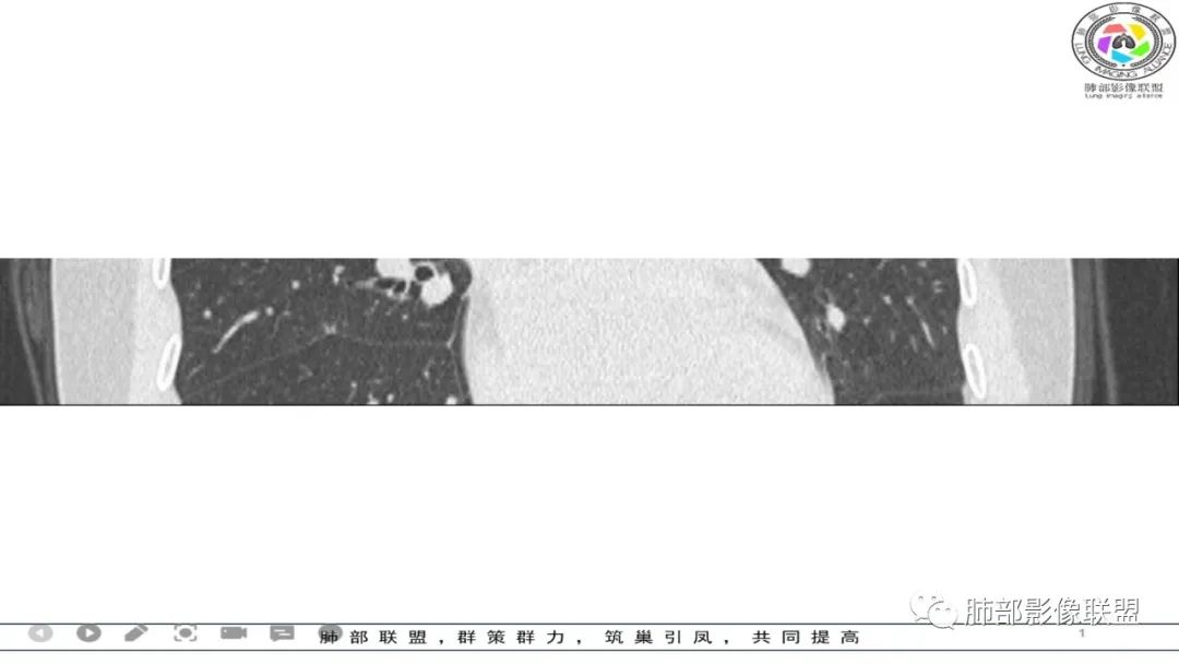 影像PPT - 【病例】 左右为难的肺结节-41 影像PPT - 【病例】 左右为难的肺结节-41