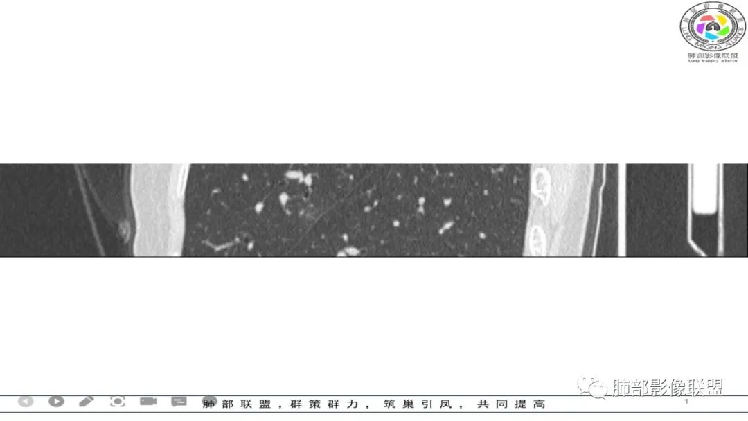 影像PPT - 【病例】 左右为难的肺结节-40 影像PPT - 【病例】 左右为难的肺结节-40