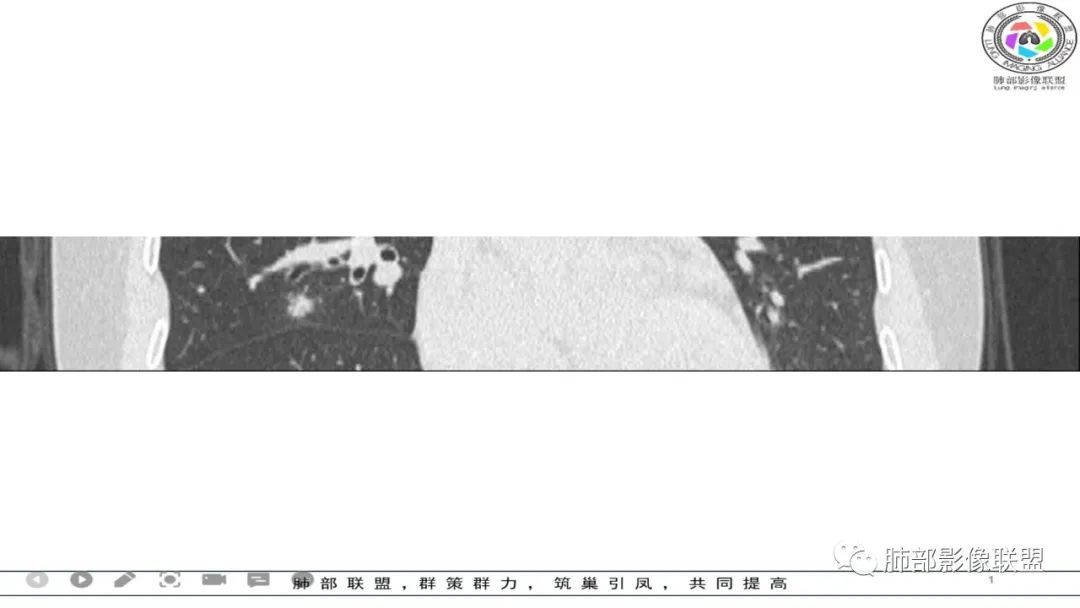 影像PPT - 【病例】 左右为难的肺结节-54 影像PPT - 【病例】 左右为难的肺结节-54