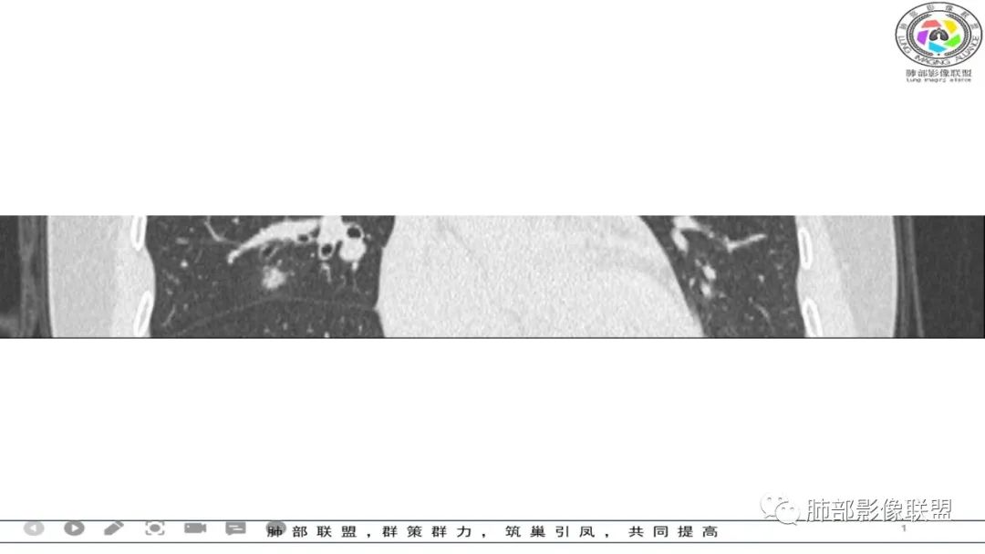 影像PPT - 【病例】 左右为难的肺结节-55 影像PPT - 【病例】 左右为难的肺结节-55