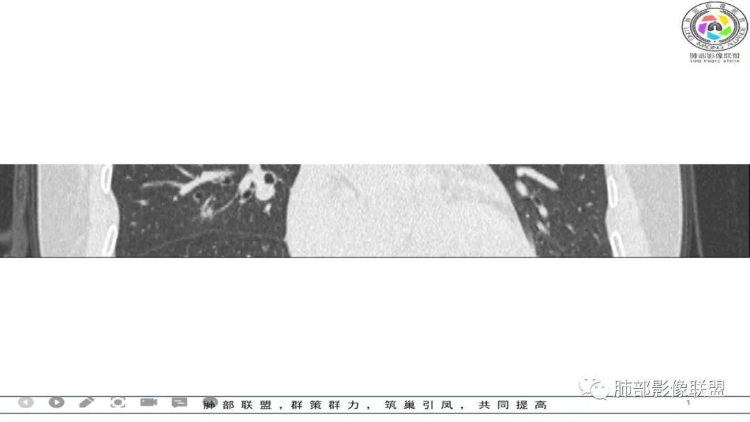 影像PPT - 【病例】 左右为难的肺结节-60 影像PPT - 【病例】 左右为难的肺结节-60