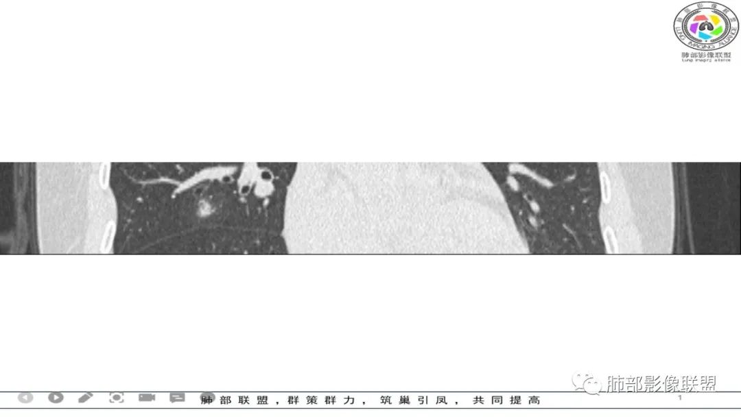 影像PPT - 【病例】 左右为难的肺结节-57 影像PPT - 【病例】 左右为难的肺结节-57