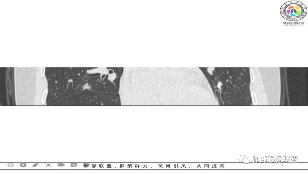 影像PPT - 【病例】 左右为难的肺结节-48 影像PPT - 【病例】 左右为难的肺结节-48
