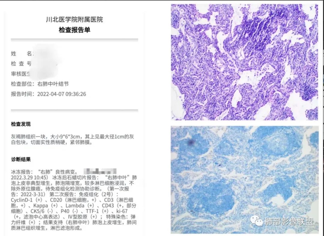 影像PPT - 【病例】 左右为难的肺结节-63 影像PPT - 【病例】 左右为难的肺结节-63