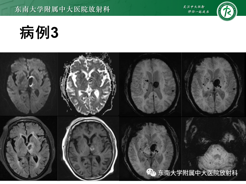 影像PPT - 【PPT】神经系统疑难病例讨论-8