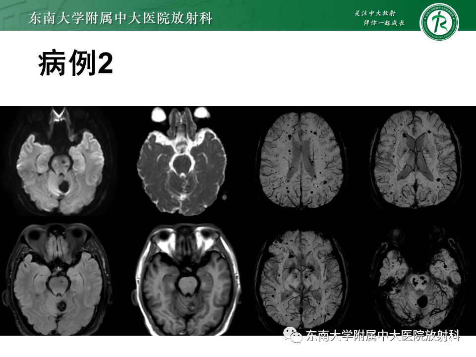 影像PPT - 【PPT】神经系统疑难病例讨论-6