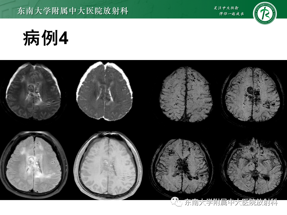 影像PPT - 【PPT】神经系统疑难病例讨论-10