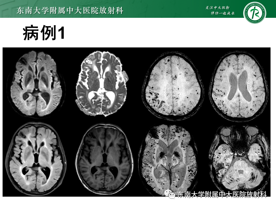 影像PPT - 【PPT】神经系统疑难病例讨论-4