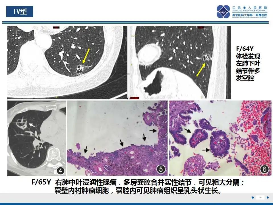 影像PPT - 【PPT】囊腔型肺癌伴胸膜转移-20