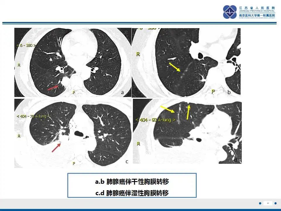 影像PPT - 【PPT】囊腔型肺癌伴胸膜转移-23