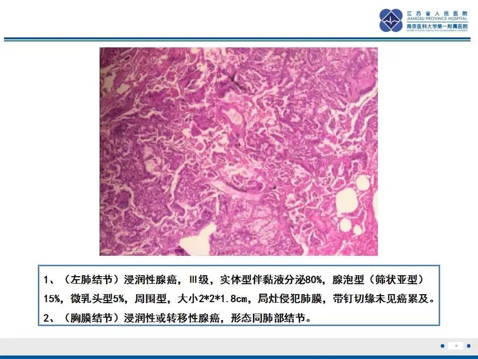 影像PPT - 【PPT】囊腔型肺癌伴胸膜转移-12