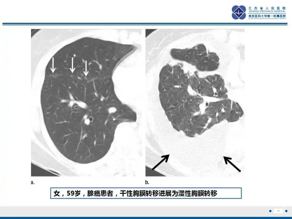 影像PPT - 【PPT】囊腔型肺癌伴胸膜转移-24