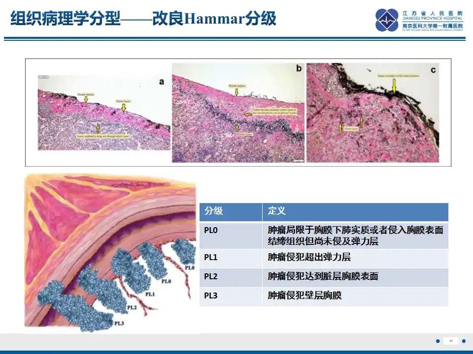 影像PPT - 【PPT】囊腔型肺癌伴胸膜转移-27