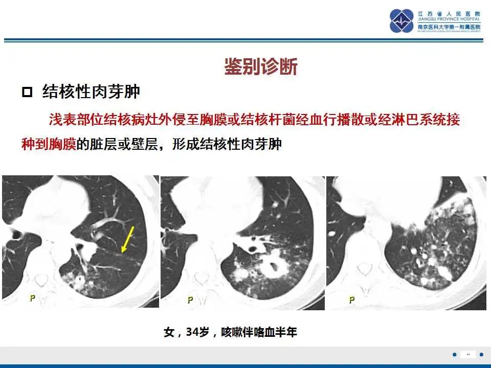 影像PPT - 【PPT】囊腔型肺癌伴胸膜转移-30