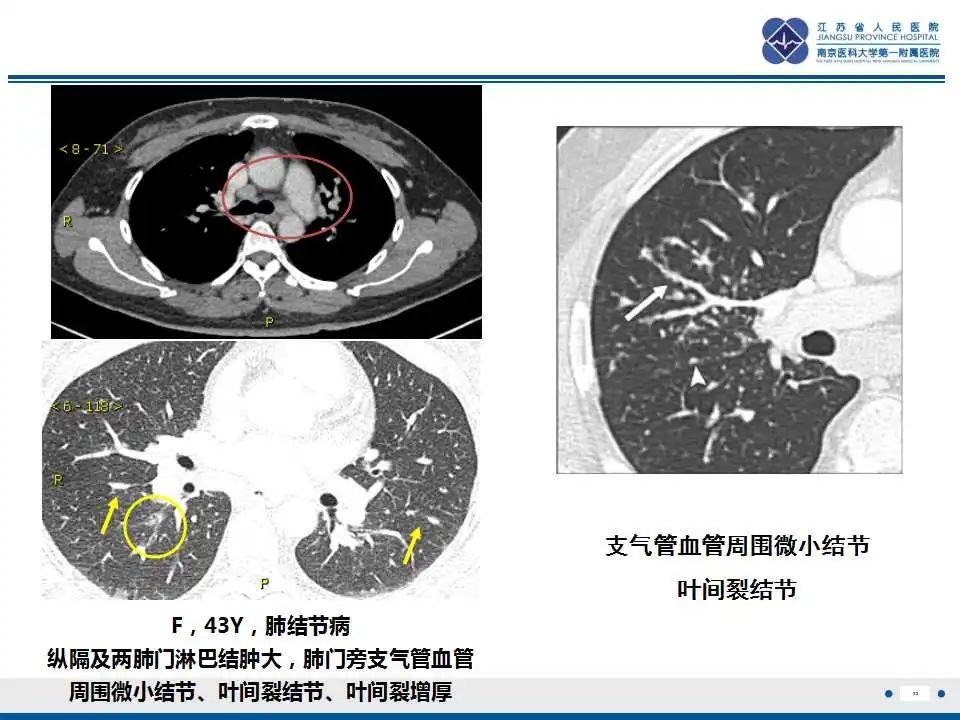 影像PPT - 【PPT】囊腔型肺癌伴胸膜转移-32