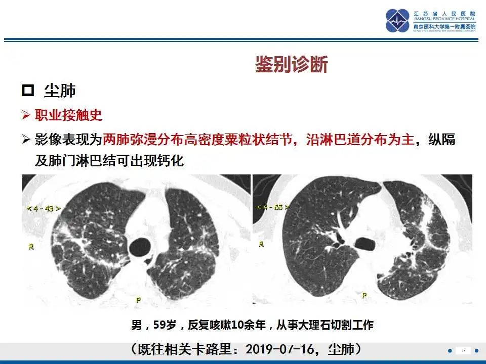 影像PPT - 【PPT】囊腔型肺癌伴胸膜转移-33