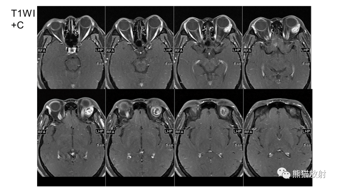 影像PPT - 【病例】泪腺多形性腺瘤2例MR影像-8