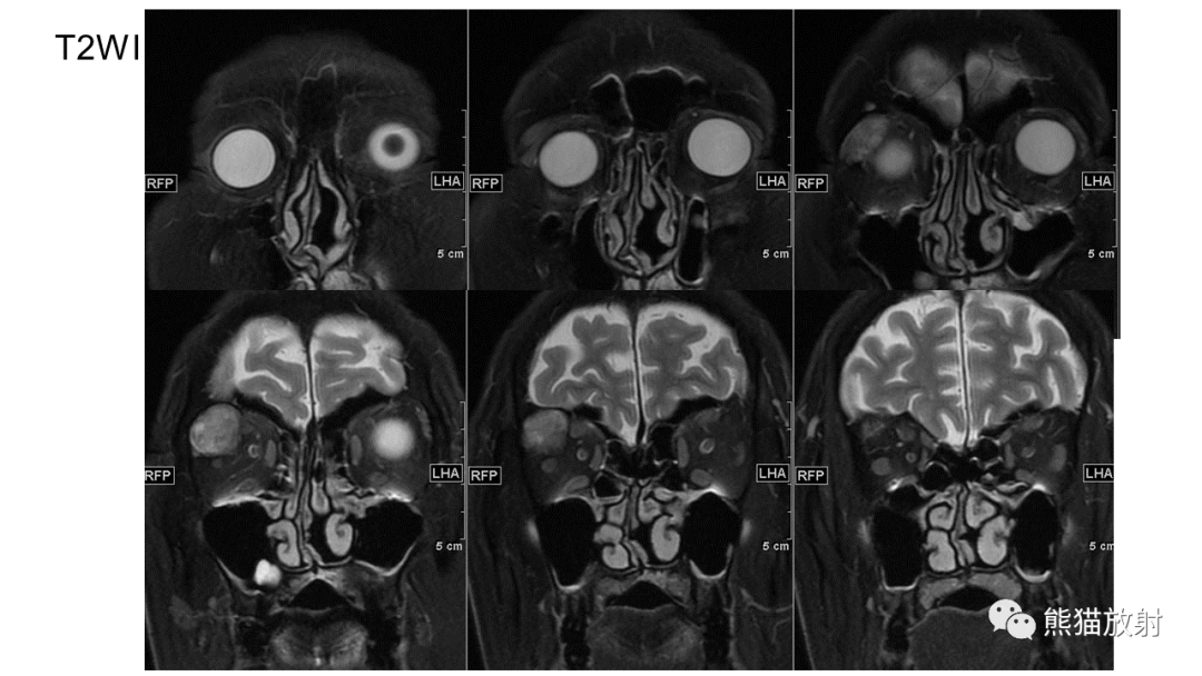 影像PPT - 【病例】泪腺多形性腺瘤2例MR影像-16