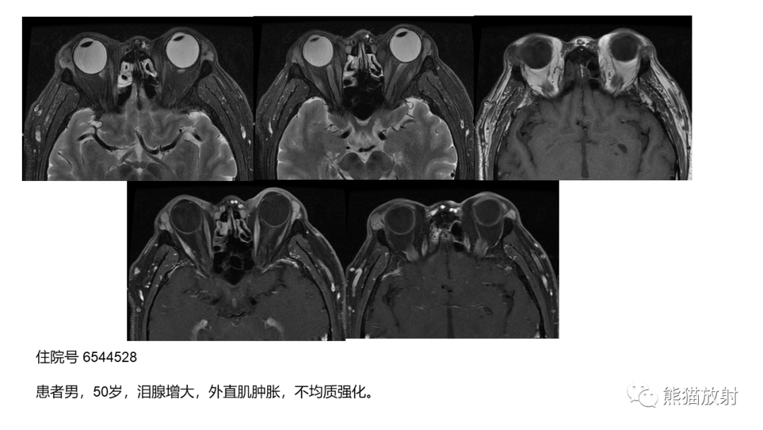 影像PPT - 【病例】泪腺多形性腺瘤2例MR影像-29