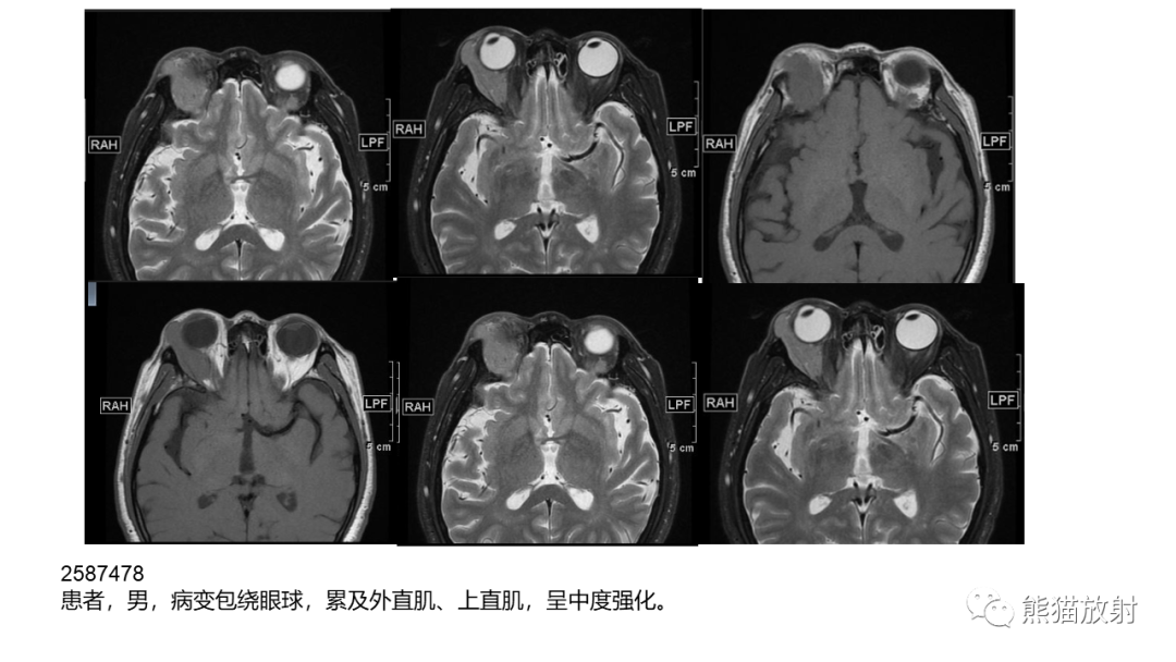 影像PPT - 【病例】泪腺多形性腺瘤2例MR影像-31