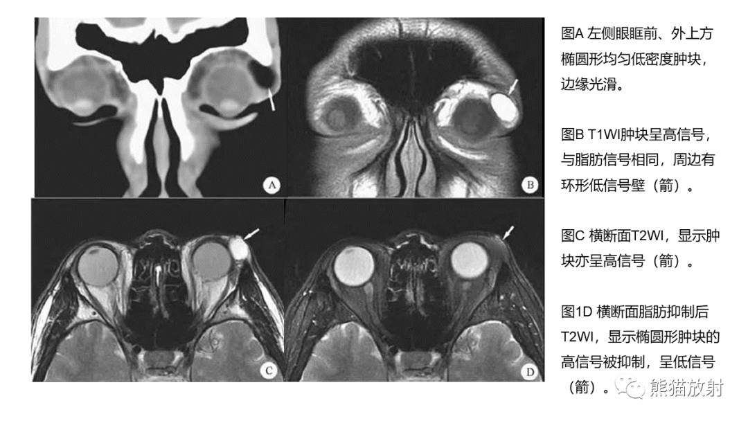 影像PPT - 【病例】泪腺多形性腺瘤2例MR影像-33