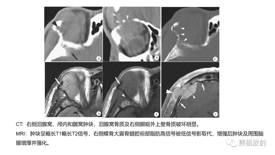 影像PPT - 【病例】泪腺多形性腺瘤2例MR影像-35