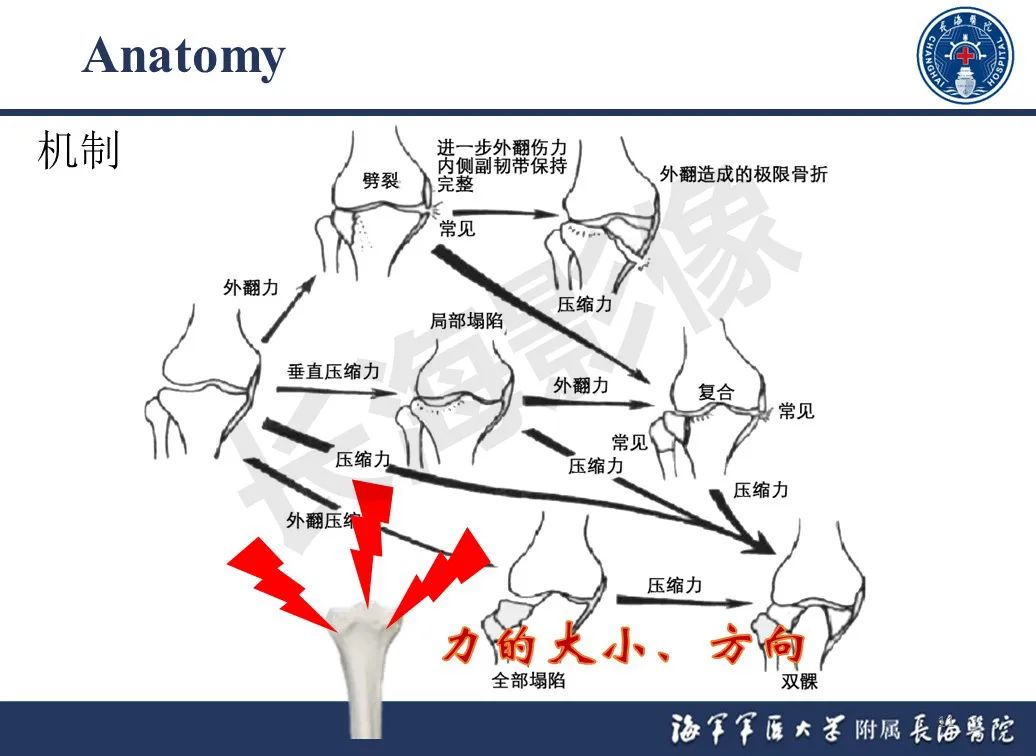 影像PPT - 【PPT】胫骨平台骨折三柱理论：骨科医生想知道什么-11